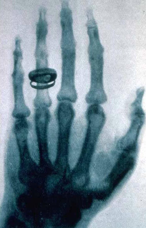 Early x-ray of Röntgen's wife's left hand.