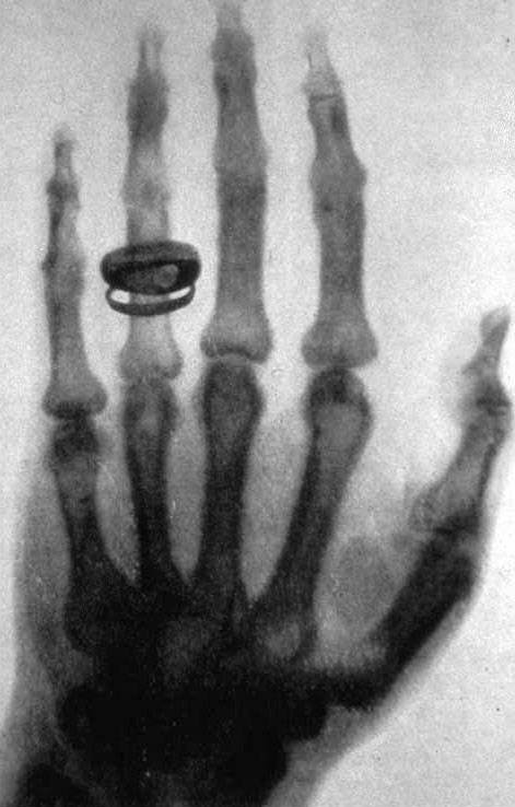 An early X-ray picture (radiograph) taken at a public lecture by Wilhelm Roentgen of Albert von Kölliker's left hand